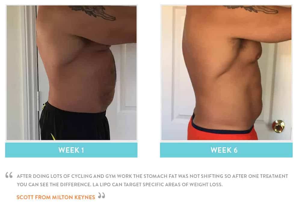Before & After Stomach Fat Higham Ferrers