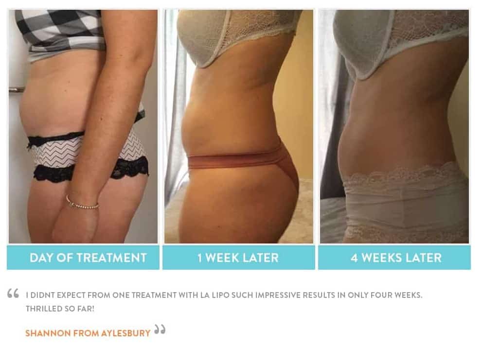 before, Cryolipolysis Higham Ferrers