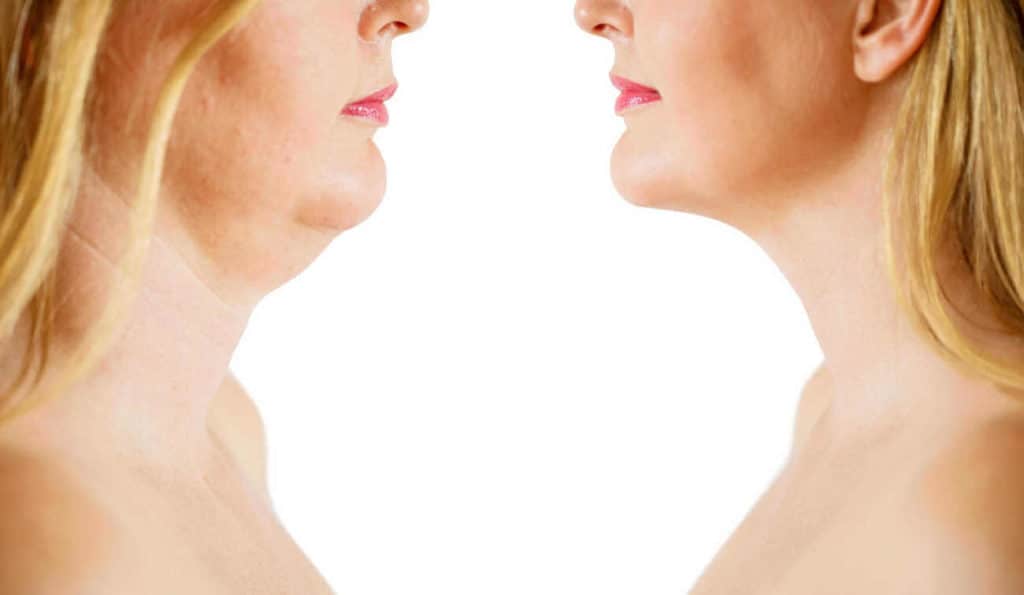Double Chin treatment Higham Ferrers before and after results