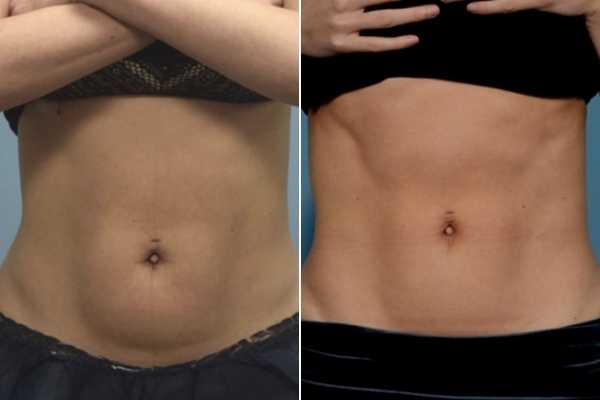 body sculpting FAQs Higham Ferrers