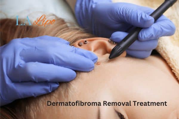 Dermatofibroma Removal Treatment Higham Ferrers