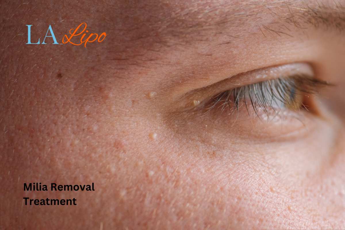 Cryopen Milia Removal: Is It the Easiest and Safest Option Higham Ferrers?