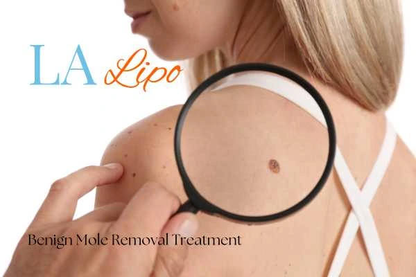Why getting moles removed Higham Ferrers can boost your confidence!