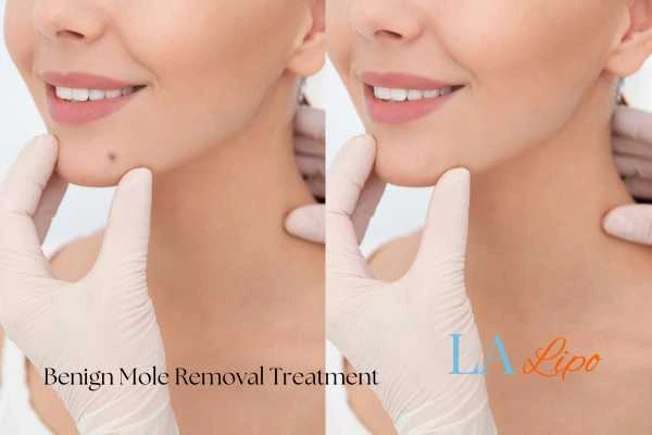 woman's before and after mole removal Higham Ferrers results