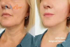 hi-fu for wrinkles Higham Ferrers before and after results