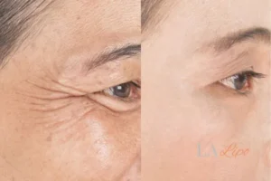 Before and after results of woman - HI-fu wrinkles reduction treatment Higham Ferrers