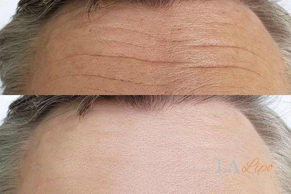 results of HIFU Higham Ferrers on mans forehead to help reduce lines and wrinkles