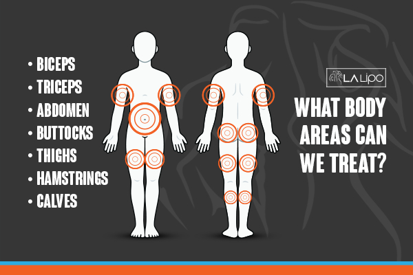 Graphic to show areas you can have LA-EMS Body Sculpting Higham Ferrers treatment.