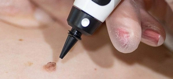 skin tag removal using cryopen Higham Ferrers