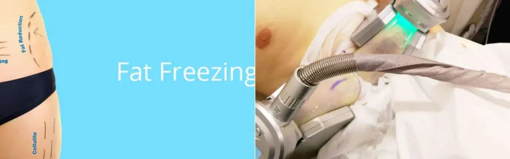 Fat freezing Higham Ferrers on multiple areas of the body