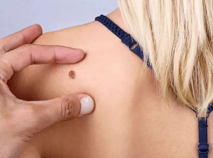 woman having mole removal Higham Ferrers consultation before treatment.