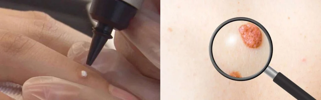 Person getting moles removed with cryopen Higham Ferrers