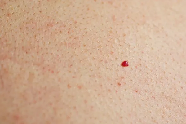 close up of a cherry angioma Higham Ferrers