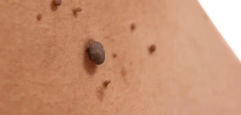 image of a skin tag Higham Ferrers