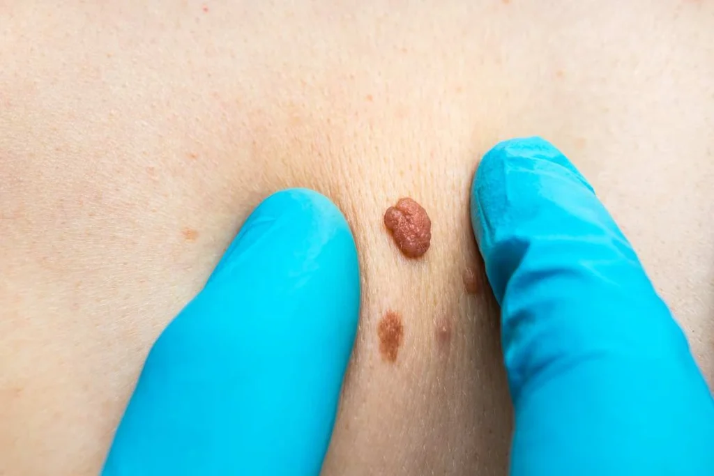 Consultant examining a skin tag Higham Ferrers