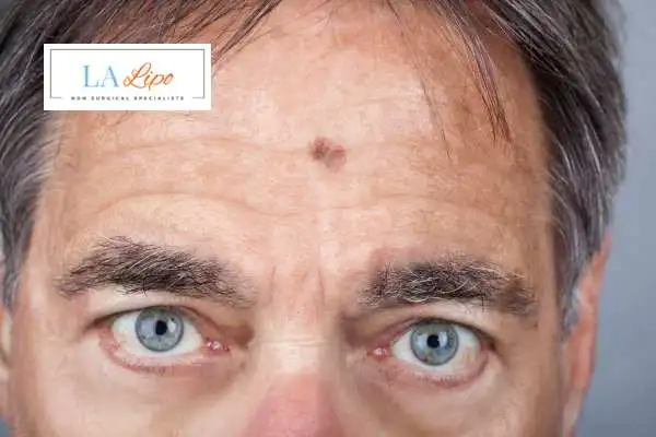 Solar Lentigo Removal Higham Ferrers image of man with mark on his forehead