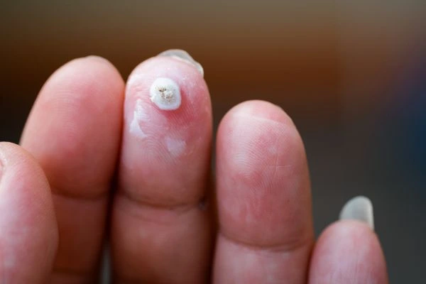 wart on person finger - cryotherapy to treat from LA LIPO Higham Ferrers