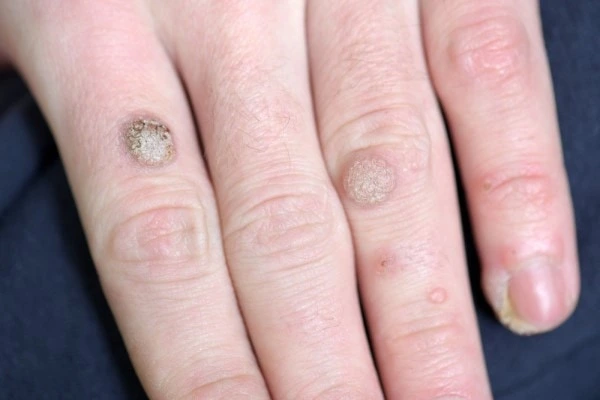 photo of warts on person hand - see wart removal Higham Ferrers from LA LIPO