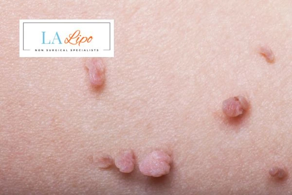 Does cryopen skin tag removal Higham Ferrers hurt? Find out now call our team today!
