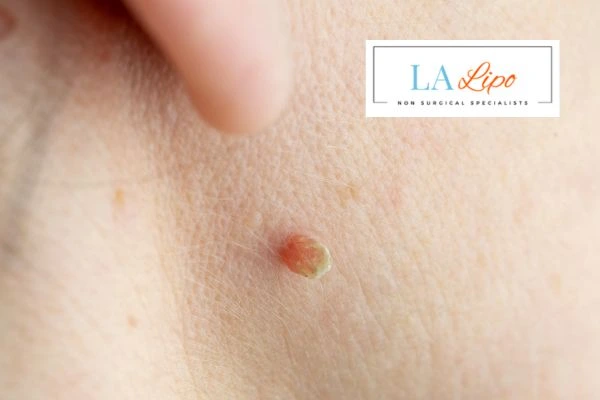 Book skin tag removal Higham Ferrers today speak to our team now!