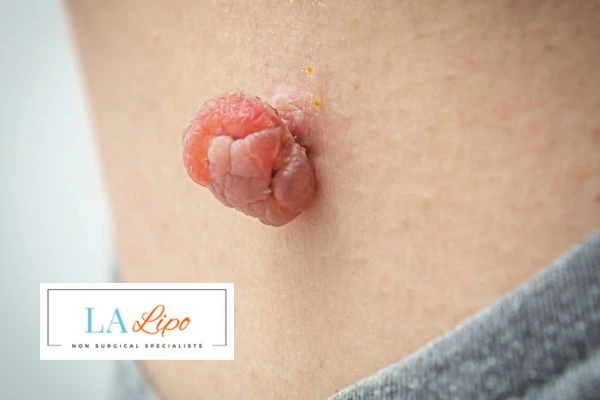 Interested in skin tag removal Higham Ferrers? Concerned about the pain? Find out more today!
