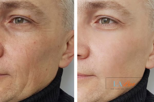 See the amazing results of Morpheus8 Treatment Higham Ferrers!