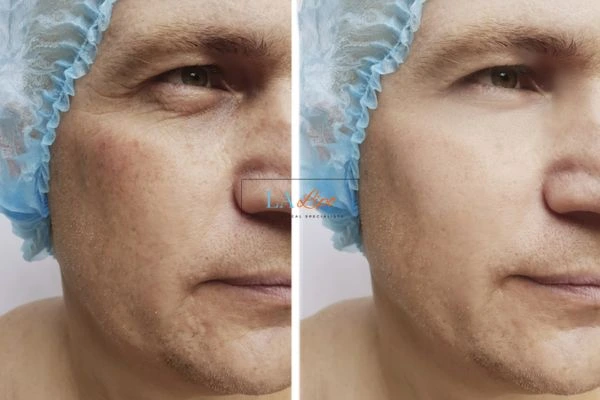 Before and after Morpheus 8 Results Higham Ferrers