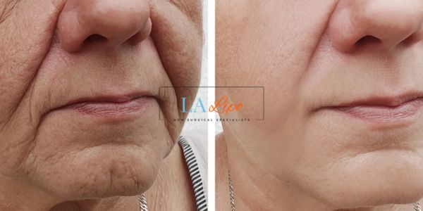 Older lady deeper wrinkle reduction - LA LIPO Morpheus 8 Results Higham Ferrers