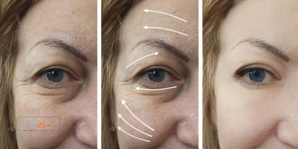 Amazing eye lift Morpheus 8 results Higham Ferrers