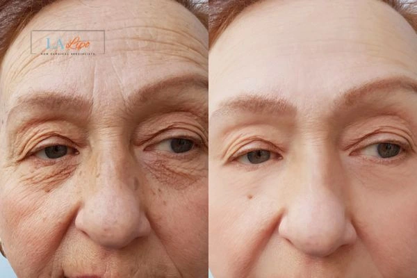 The powerful benefits of Morpheus8 Treatment Higham Ferrers - Call Our team today!