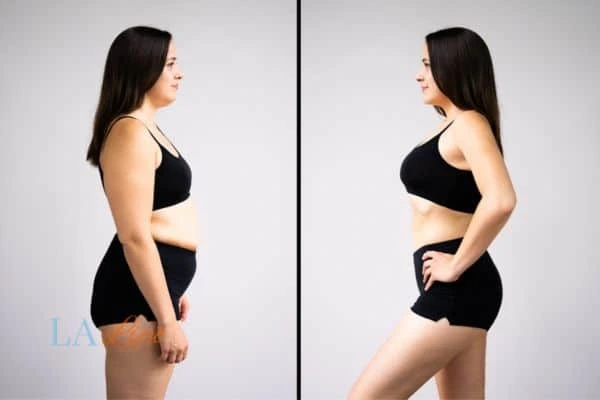 Picture of womans before and after using LA-EMS body sculpting to improve her core strength Higham Ferrers