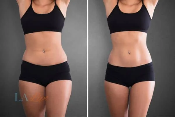 before and after results of non-surgical treatment to help a woman's body image and mental health Higham Ferrers