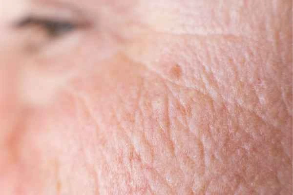 close up picture of a woman's face showing an age spot Higham Ferrers