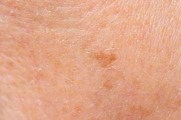 close up picture of age spots Higham Ferrers