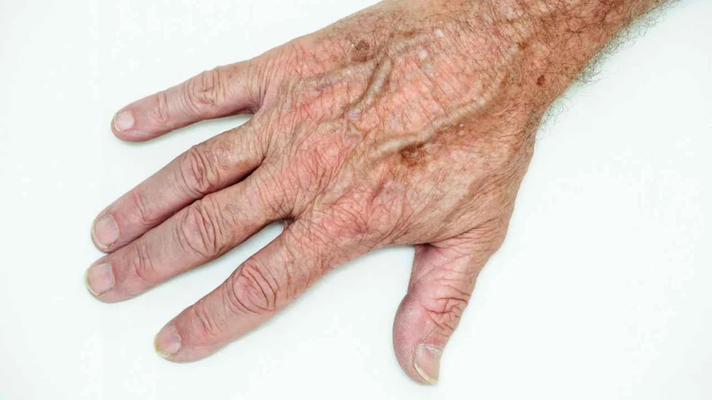 Male hand showing age spot Higham Ferrers