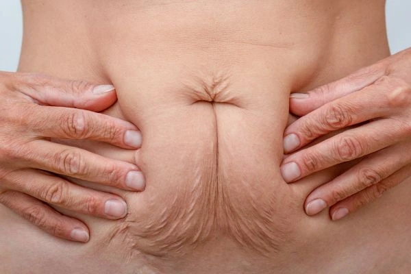 Image of a woman's stomach with loose skin - example of skin tightening Higham Ferrers options