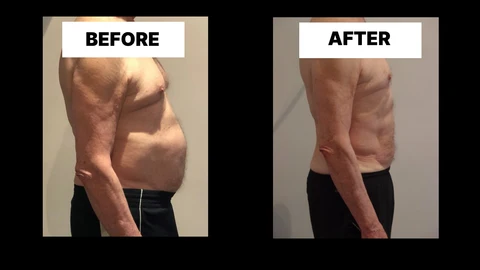 What Symptoms Can Diastasis Recti Cause in Men? Weak Core, Back Pain and Poor Posture Higham Ferrers
